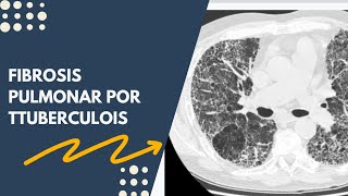 FIBROSIS PULMONAR A CONSECUENCIA DE TUBERCULOSIS Tos cronica Dificultad Respiratoria [upl. by Eetse]