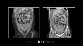 Thoracoabdominal Emergencies VI  Free Radiology CME [upl. by Dekow]