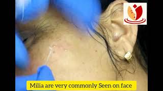 Milia removal Treatment of milia by needle extirpation Dr Charu Bansal Dermatologist Ghaziabad [upl. by Hanima221]