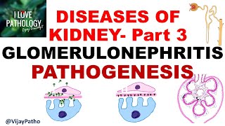 RENAL PATHOLOGY Part 3  Glomerulonephritis PATHOGENESIS [upl. by Rehtnug]