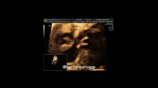 Can Fetal Echocardiography Really Detect Heart Block Early [upl. by Opal310]