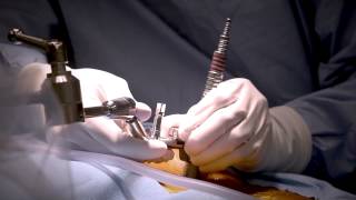 Minimally Invasive Laminectomy Surgery to Treat Lumbar Stenosis  MedStar Southern Maryland [upl. by Caplan]