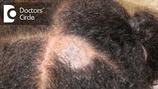 What causes Scalp Ringworm Effective Treatment   Tinea Capitis  Dr Tina Ramachander [upl. by Freed561]