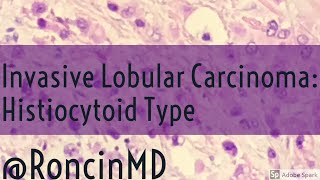 Short Review Invasive Lobular Carcinoma Breast  Histiocytoid Type [upl. by Farhsa87]