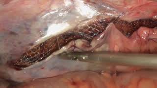 Laparoscopic Inguinal Hernia Repair TAPP 9  TAPP Plus [upl. by Elleniad]