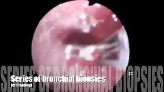 bronchial biopsy [upl. by Webb29]