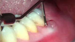 Endodontics Torabinejad 61 Perio of Pulpal Origin [upl. by Nero]