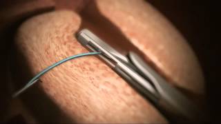 Animation of Urolift® System for BHP  Treatment now available at Genesis Healthcare [upl. by Det]