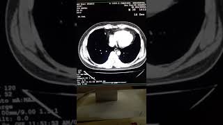 CT UROGRAPHY [upl. by Brien]