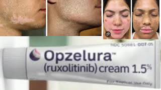 Opzelura ruxolitinib cream [upl. by Glarum]