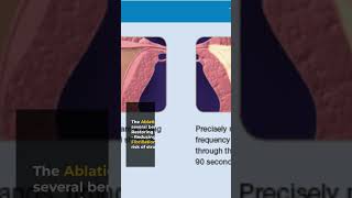 Painless Pulmonary Vein Isolation Your Ultimate Guide to Atrial Fibrillation Ablation [upl. by Campos]