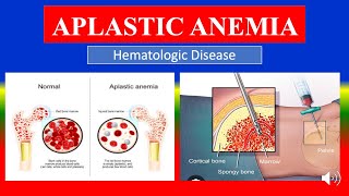 APLASTIC ANEMIA  Definition types causes pathophysiology signs amp symptoms medicine [upl. by Arnoldo]