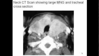 Multinodular Goiter Evaluation and Management [upl. by Anigue123]