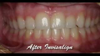 Invisalign Express with WhiteningBefore amp AfterMick Family Dental Care [upl. by Castillo]