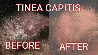 TINEA CAPITIS UPDATE [upl. by Eenimod]