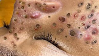 loan nguyen acne amp spa 31 [upl. by Inan]