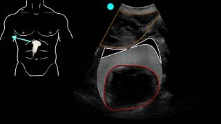 POCUS  Positive EFAST exam with hemopericardium [upl. by Semyaj]