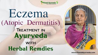 Eczema Atopic Dermatitis Treatment in Ayurveda with Herbal Remedies [upl. by Nalyd]