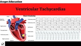 Identifying the Different Types of Ventricular Tachycardias [upl. by Izaak745]