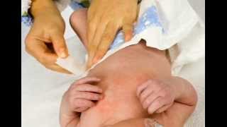 Diaper Rash 1 Symptoms types such as irritant yeast allergic [upl. by Richelle]