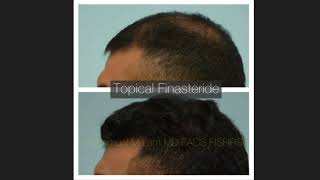 Dallas Topical Finasteride Before and After [upl. by Anneehs461]