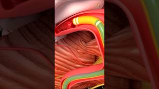 Thrombectomy machanical shorts medical science health nursingking [upl. by Niarda]