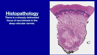 Lecture110 Necrobiotic Granulomatous Disorders of the Skin Rooks chapter 97 [upl. by Nitfa371]