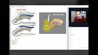 Jersey finger and Mallet Finger Short topics by Ankit Shahi for your NPTE prep NPTE StudyBuddy [upl. by Tatman370]