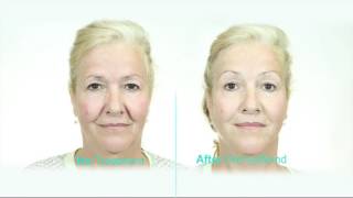 Dermawand International HD 2016 [upl. by Rabkin240]