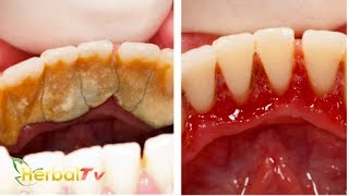 Cara MERONTOKKAN Karang Gigi Paling AMPUH dan CEPAT  Easily Remove Plaque and Tartar [upl. by Devaney]