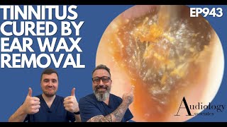 TINNITUS CURED BY EAR WAX REMOVAL  EP943 [upl. by Giustina]