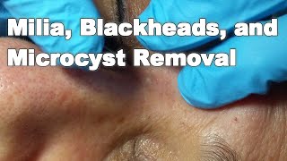 Milia Blackheads and Microcyst Removal [upl. by Guenzi729]