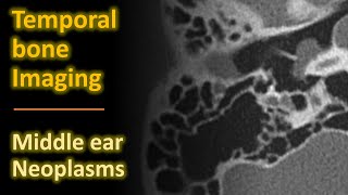 Temporal Bone Imaging  Glomus tympanicum amp other middle ear neoplasms [upl. by Conan997]