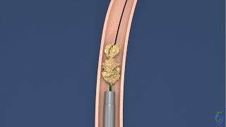 Ureterolitotripsia Rigida  Animação cirurgia de pedra no ureter  Tratamento de cólica renal [upl. by Lashond139]