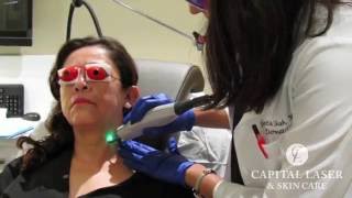 Vascular Laser Scar Removal at Capital Laser amp Skin Care [upl. by Arrotal]