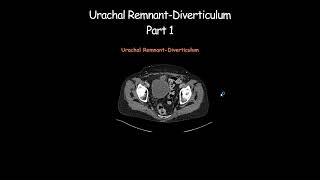 Urachal RemnantDiverticulum Part 1 radiology radiologist embryology urinarybladder [upl. by O'Kelly]