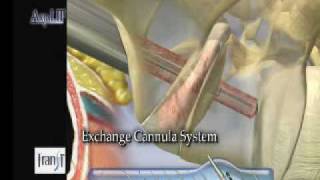 Bone  AxiaLIF System [upl. by Ayet649]