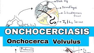 onchocerciasis  River blindness  Life cycle symptoms and treatment  Bio science [upl. by Leahcam]