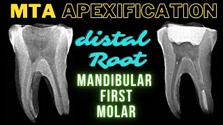 MTA APEXIFICATION  Mandibular First Molar  Apexification Step by Step [upl. by Hulton]