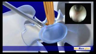 maxMorespine endoscopic animation [upl. by Enineg609]