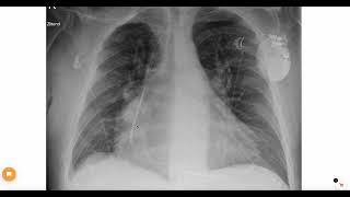 The difference between pacemakers and ICDs on a chest X ray [upl. by Soracco]