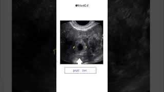 Essential Radiological Signs in OBGYN for NEET PG INICET and FMGE 📚 pwmeded [upl. by Lainad]