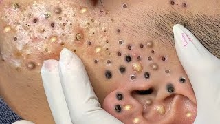 Big Cystic Acne Blackheads Extraction Blackheads amp Milia Whiteheads Removal Pimple Popping  9157 [upl. by Tortosa914]