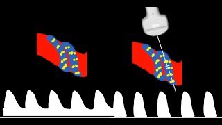 Umbilical Artery Doppler interpretation [upl. by Cis]