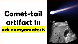 Comet ☄️ tail artifact in adenomyomatosis [upl. by Eidda196]