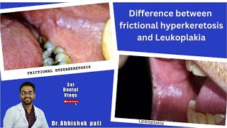 DIFFERENCE BETWEEN FRICTIONAL HYPERKERATOSIS AND LEUKOPLAKIA [upl. by Davidson]