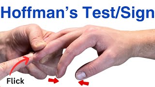 How to Perform a Hoffmans Test  Inverted Supinator Sign  Clonus  Hyperreflexia [upl. by Eidnak]