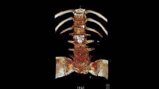 L45 spondylolytic spondylolisthesis [upl. by Joline]