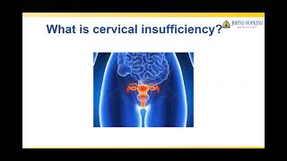 Treatment of Cervical Insufficiency [upl. by Smalley]