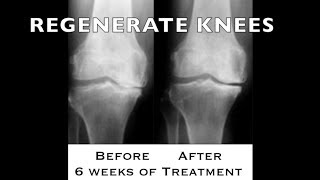 REGENERATE YOUR KNEES no surgery needed 18  httpsdrstephenstokescom [upl. by Nevaed96]